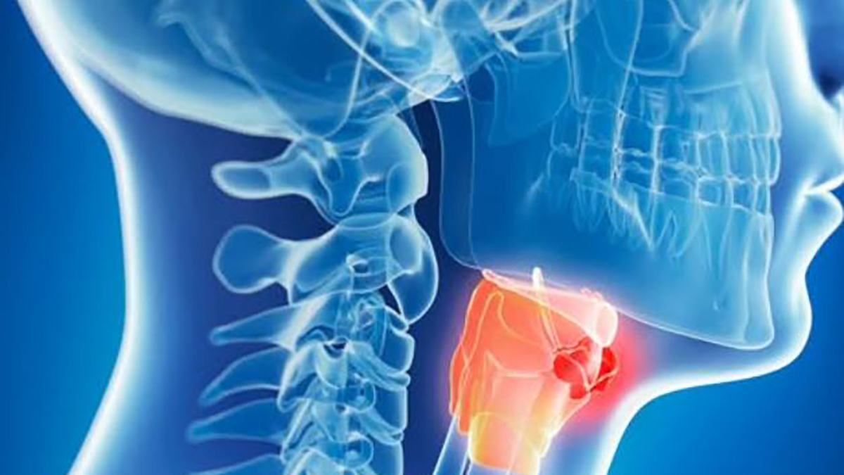 Tumori testa-collo, la regola per riconoscerli: ecco i segnali da non sottovalutare